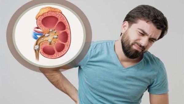 مشروبات طبيعية فعالة لطرد الأملاح وتفتيت حصوات الكلى
