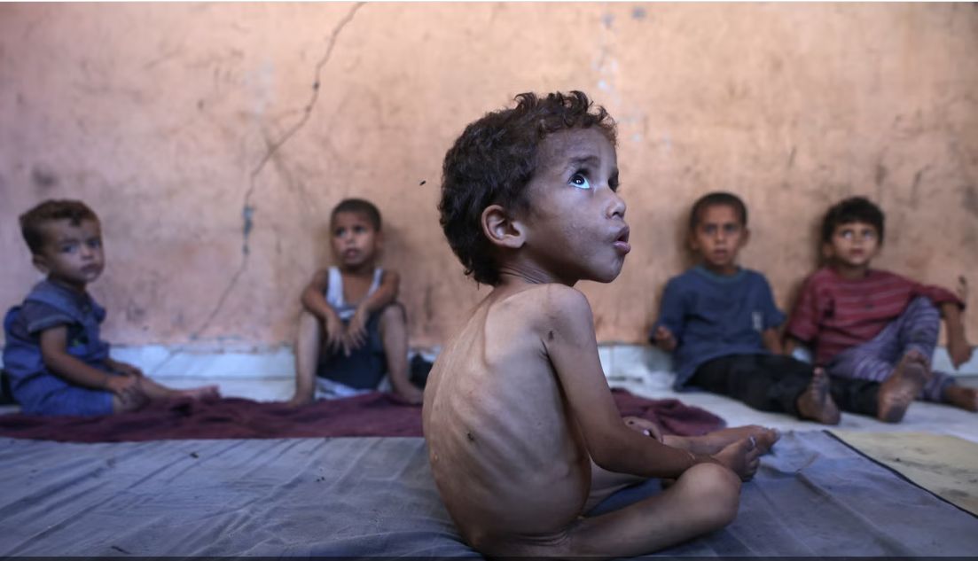الاطفال فى غزة يعانون سوء التغذية الاطفال فى غزة يعانون سوء التغذية
