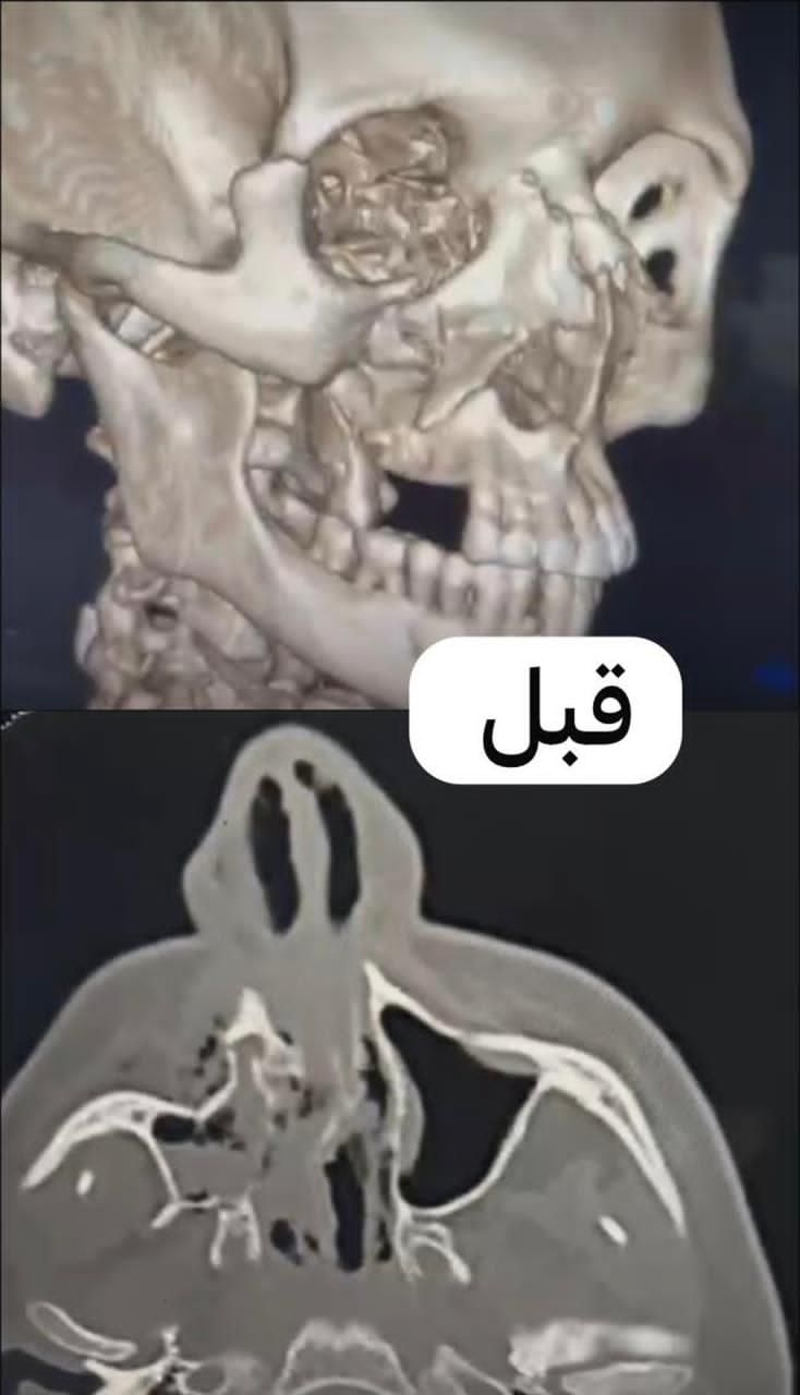 قبل بعد العملية