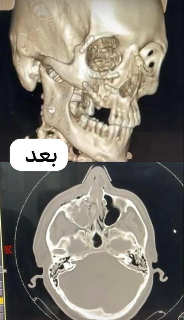 بعد العملية