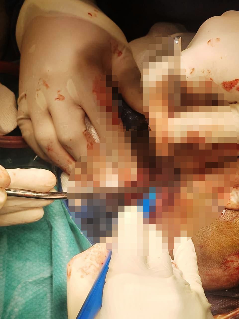 نجاح جراحة عاجلة لإنقاذ مصاب بآلة حادة نافذة بالمخ بمستشفى طوارئ قصر العينى (1) نجاح جراحة عاجلة لإنقاذ مصاب بآلة حادة نافذة بالمخ بمستشفى طوارئ قصر العينى (1)