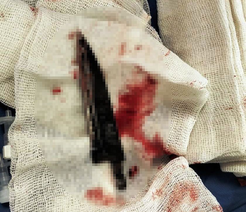 نجاح جراحة عاجلة لإنقاذ مصاب بآلة حادة نافذة بالمخ بمستشفى طوارئ قصر العينى (4) نجاح جراحة عاجلة لإنقاذ مصاب بآلة حادة نافذة بالمخ بمستشفى طوارئ قصر العينى (4)