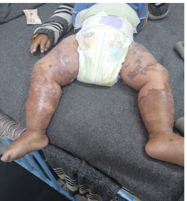 قدم الطفل محمد زنون قدم الطفل محمد زنون