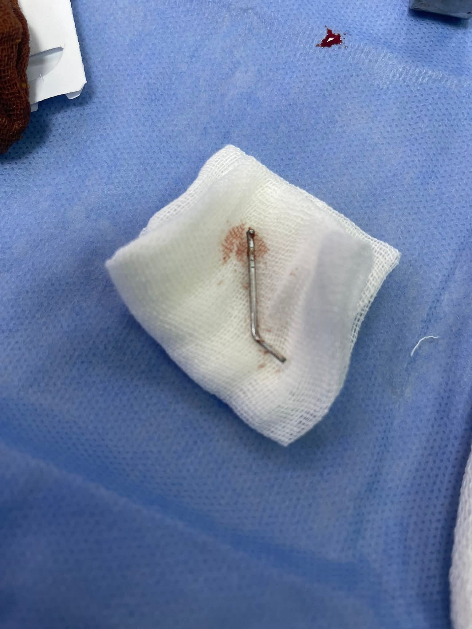 المسمار بعد استئصاله المسمار بعد استئصاله