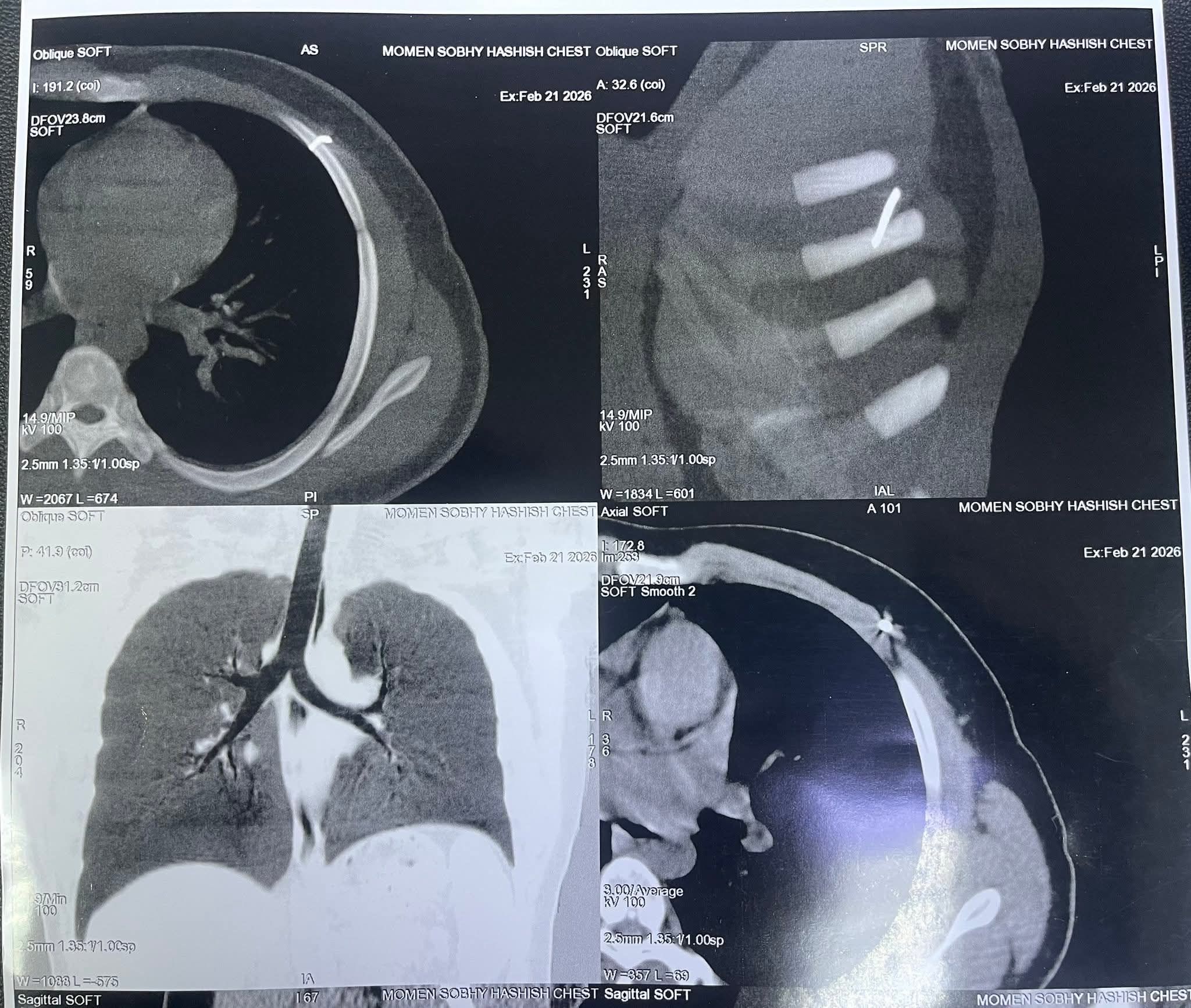 الأشعة توضح مكان المسمار الأشعة توضح مكان المسمار