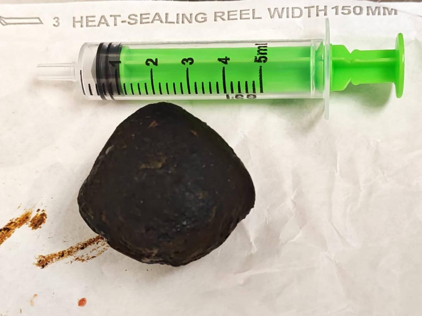 الحصوة المستخرجة الحصوة المستخرجة