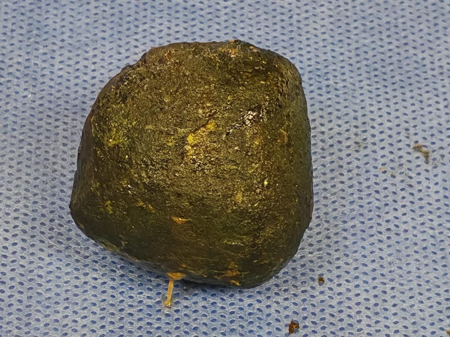 الحصة المرارية المستخرجة من المعدة الحصة المرارية المستخرجة من المعدة