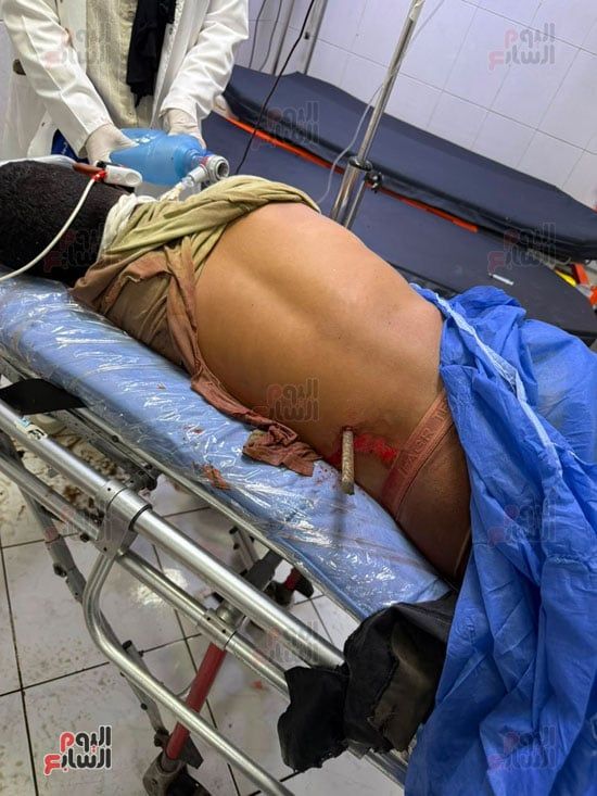 سيخ حديدي يخترق جسد الشاب سيخ حديدي يخترق جسد الشاب