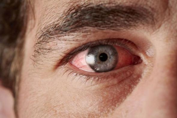 طبيب: احذر إهمال احمرار العين.. قد يسبب الإصابة بالعمى
