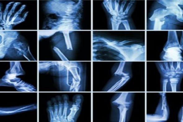 كيف يتم تشخيص مرض العظم الزجاجي؟