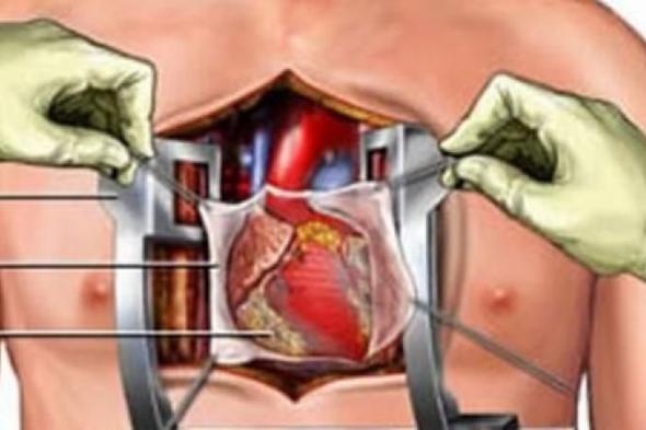 بالبلدي : نصائح ضرورية قبل إجراء عملية القلب المفتوح.. أبرزهم التوقف عن الأسبرين