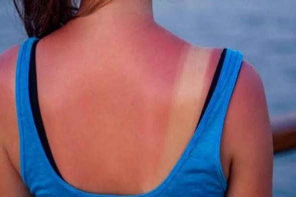 كيف يمكن لحروق الشمس أن تسبب سرطان الجلد؟