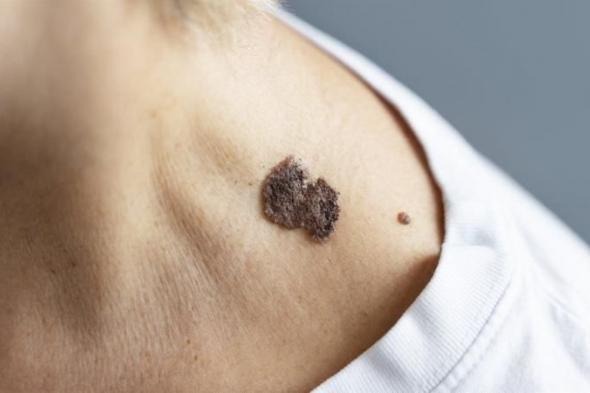 بالبلدي : سرطان الجلد.. نصائح مهمة للحماية
