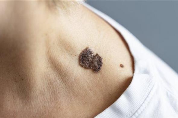 سرطان الجلد.. نصائح مهمة للحماية