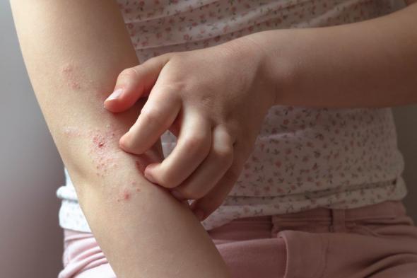 الأطفال والإكزيما: كيف تسبب حالة الجلد مشكلات في التعلم والذاكرة؟!