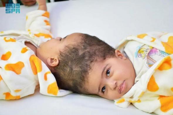 نجاح عملية فصل التوأم الملتصق الإريتري "أسماء وسمية" بعد عملية استغرقت 15 ساعة ونصفاً
