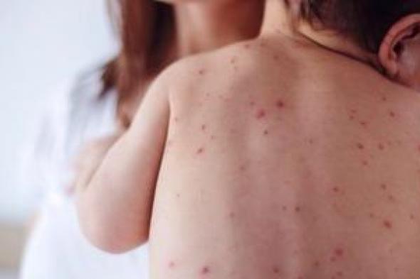 أزمة
صحية
فى
إسرائيل..
وفاة
15
طفلاً
بسبب
تفشى
الحصبة