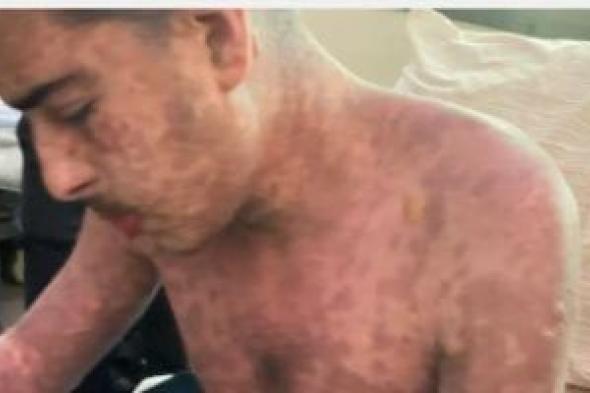 بعد
أيام
من
نشر
قصته..
وفاة
الشاب
الفلسطيني
محمد
ضبان
بمتلازمة
ستيفن
جونسون