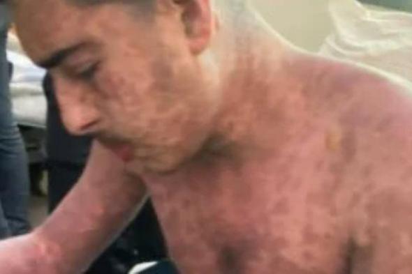 بعد أيام من نشر قصته.. وفاة الشاب الفلسطيني محمد ضبان بمتلازمة ستيفن جونسون