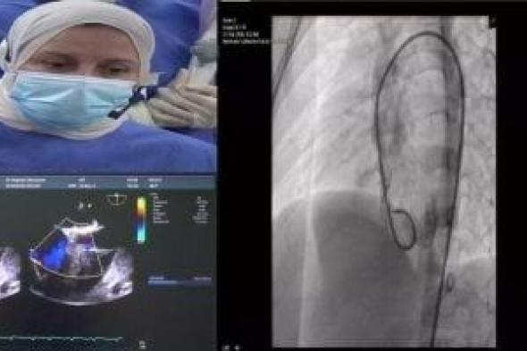 إجراء
بث
حى
لقسطرتين
قلبيتين
تداخليتين
لعيوب
القلب
الخلقية
للأطفال
بجامعة
طنطا