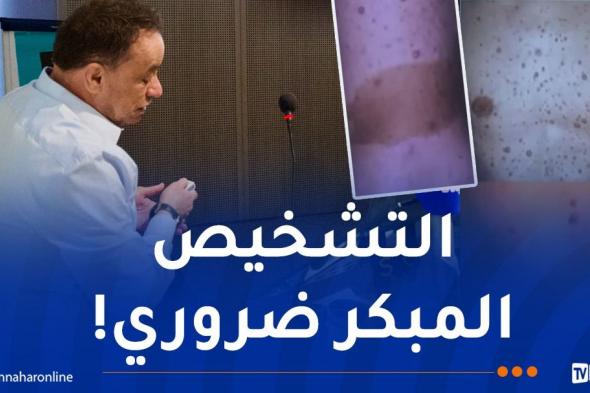 أطباء
يحذّرون..
هذه
أعراض
الورم
الليفي
العصبي
من
النوع
الأول
(NF1)