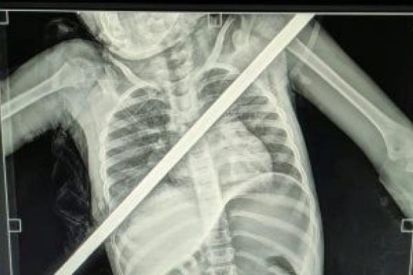 3
ساعات
فى
العمليات..
إنقاذ
حياة
طفلة
اخترق
سيخ
حديد
صدرها
فى
بنها
الجامعى